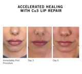 Cu3 Lip Repair - NEOVA