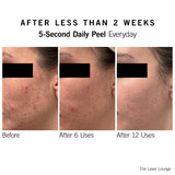 Before and after results from NEOVA 5-Second Daily Peel showing smoother skin texture after exfoliation