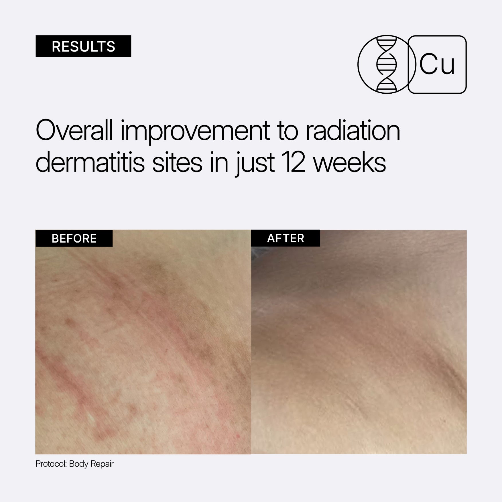 NEOVA Body Repair - before and after results comparison close up showing overall improvement to radiation dermatitis sites in just 12 weeks.