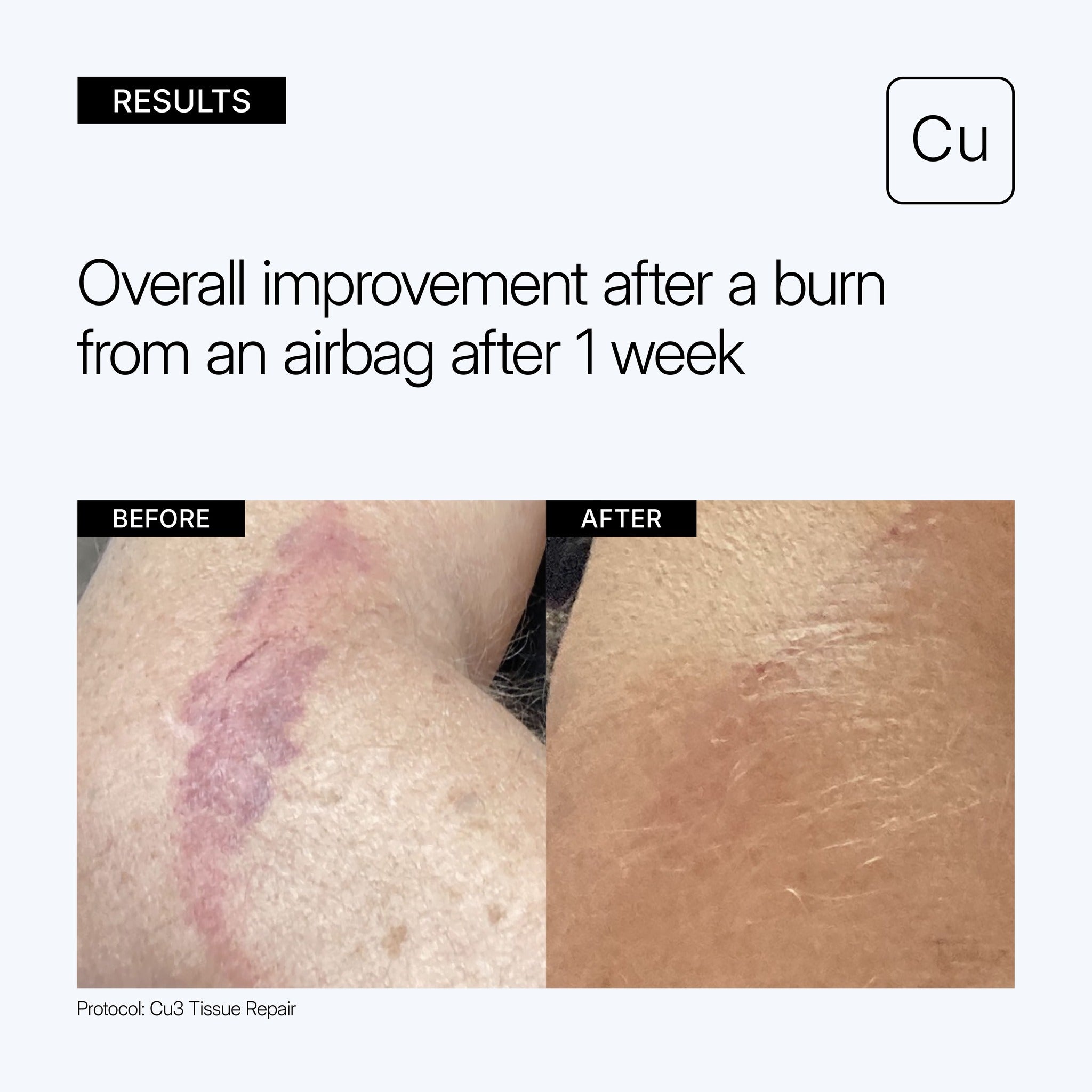 NEOVA Cu3 Tissue Repair educational image showing clinical before and after results with 'Overall improvement after a burn from an airbag after 1 week' on a gray background.