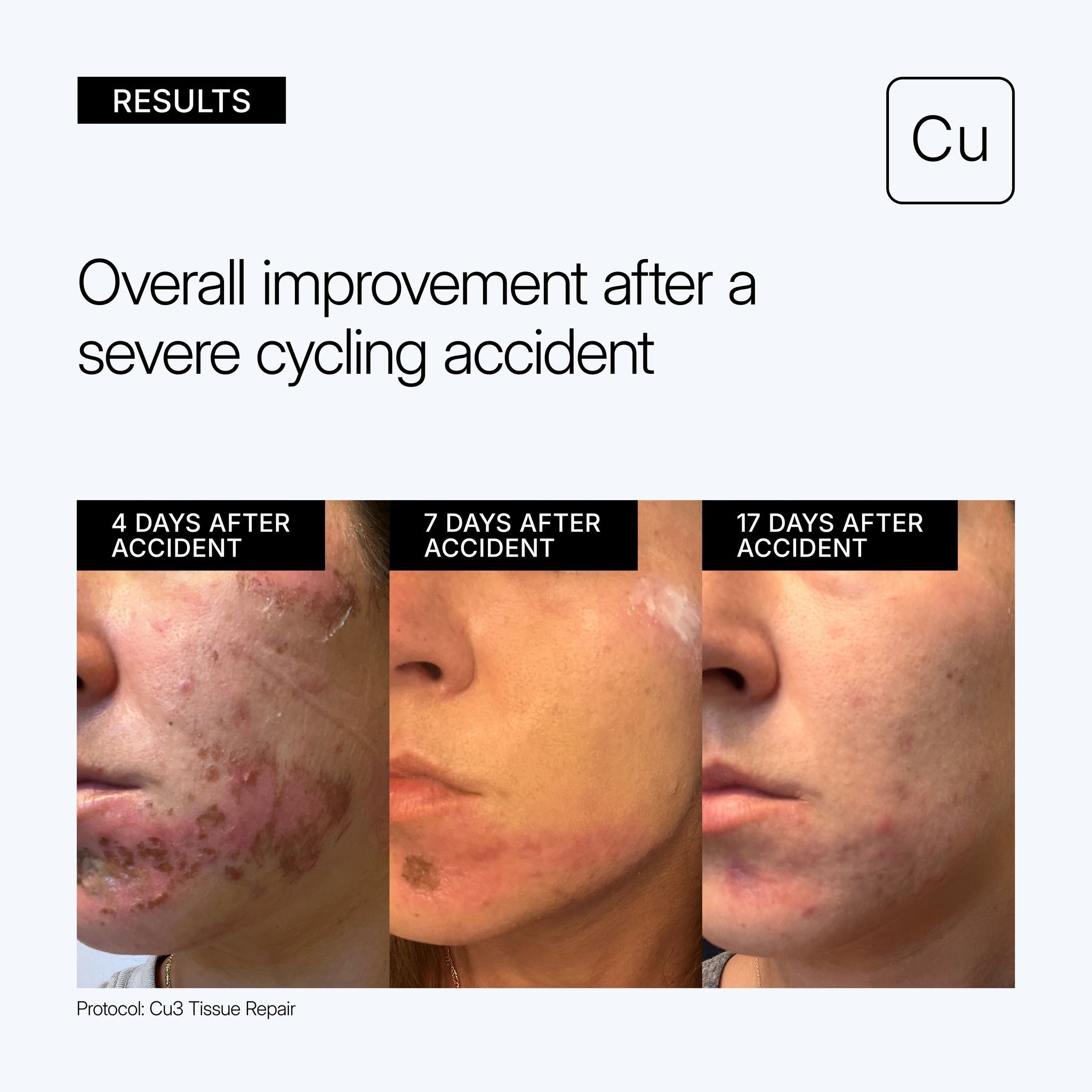 NEOVA Cu3 Tissue Repair educational image showing clinical before and after results showing overall improvement 4 days, 7 days, and 17 days after a severe cycling accident on a gray background.