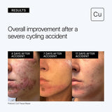 NEOVA Cu3 Tissue Repair educational image showing clinical before and after results showing overall improvement 4 days, 7 days, and 17 days after a severe cycling accident on a gray background.