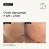 NEOVA Serious Clarity 4X Serum educational image showing clinical before and after results with 'Overall improvement in just 4 weeks' on a gray background.