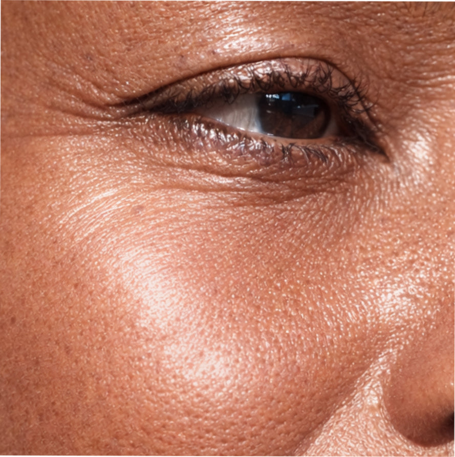 Crow's Feet Wrinkles: What Causes Them and What Actually Helps