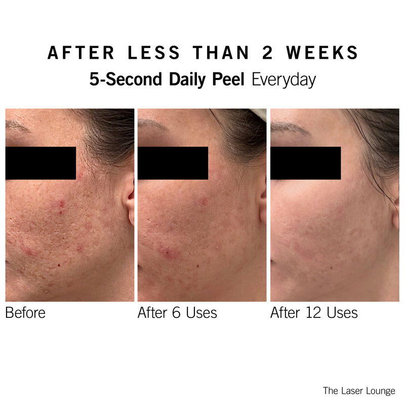 5-Second Daily Peel - NEOVA