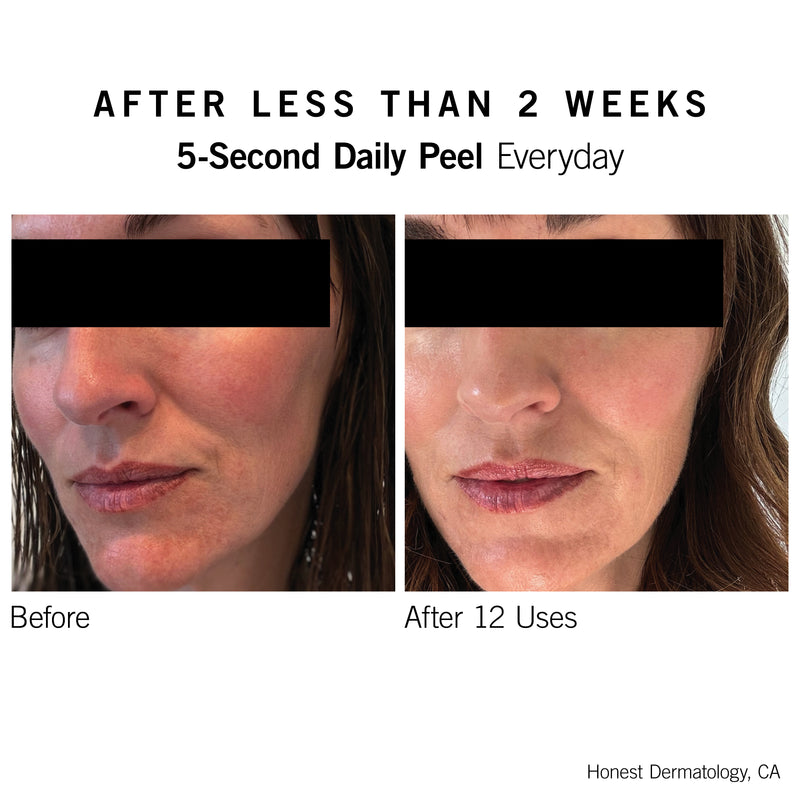 5-Second Daily Peel - NEOVA