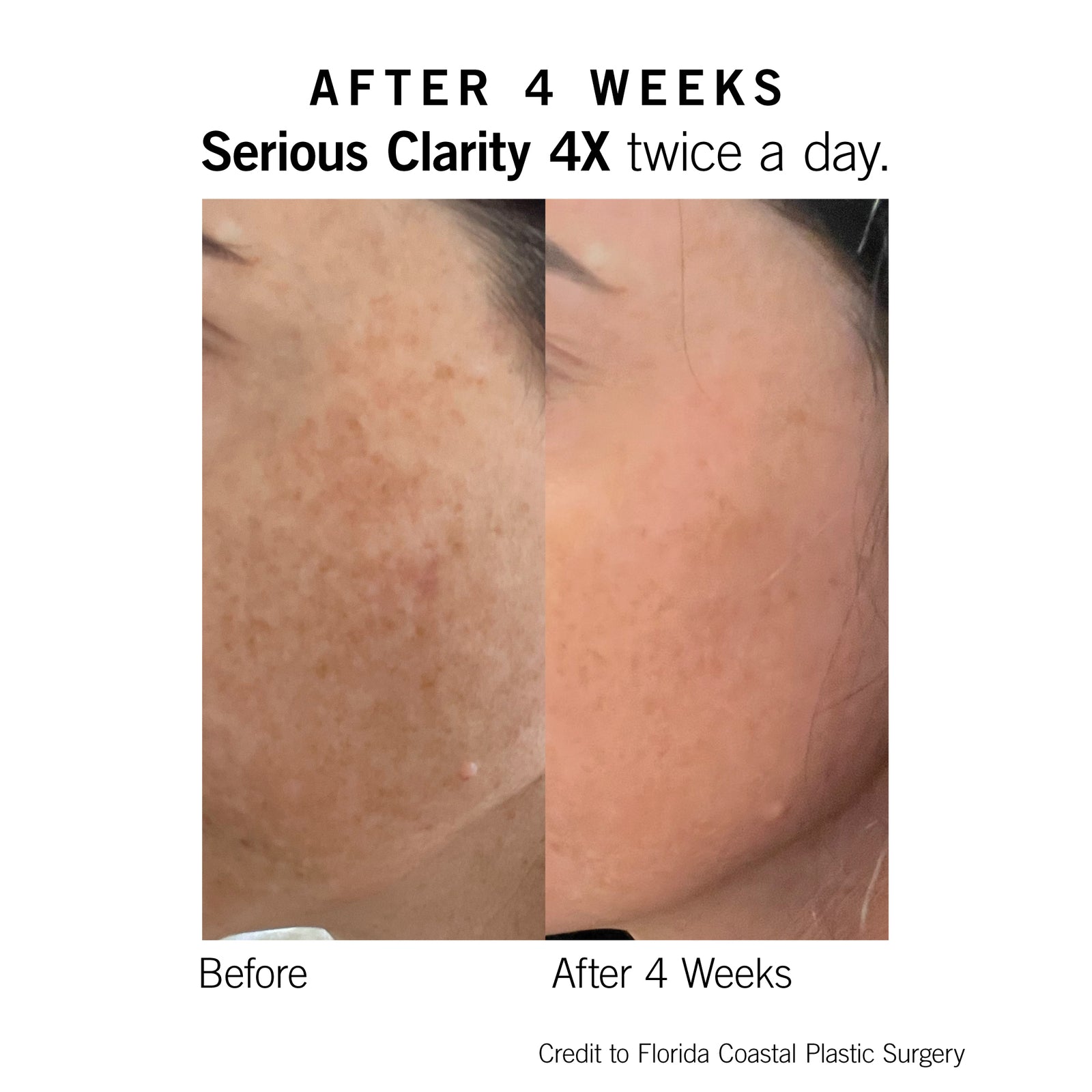 Serious Clarity 4X | NEOVA® SmartSkincare