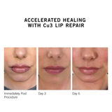 Cu3 Lip Repair - NEOVA