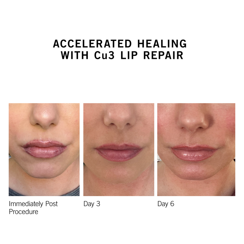 Cu3 Lip Repair - NEOVA