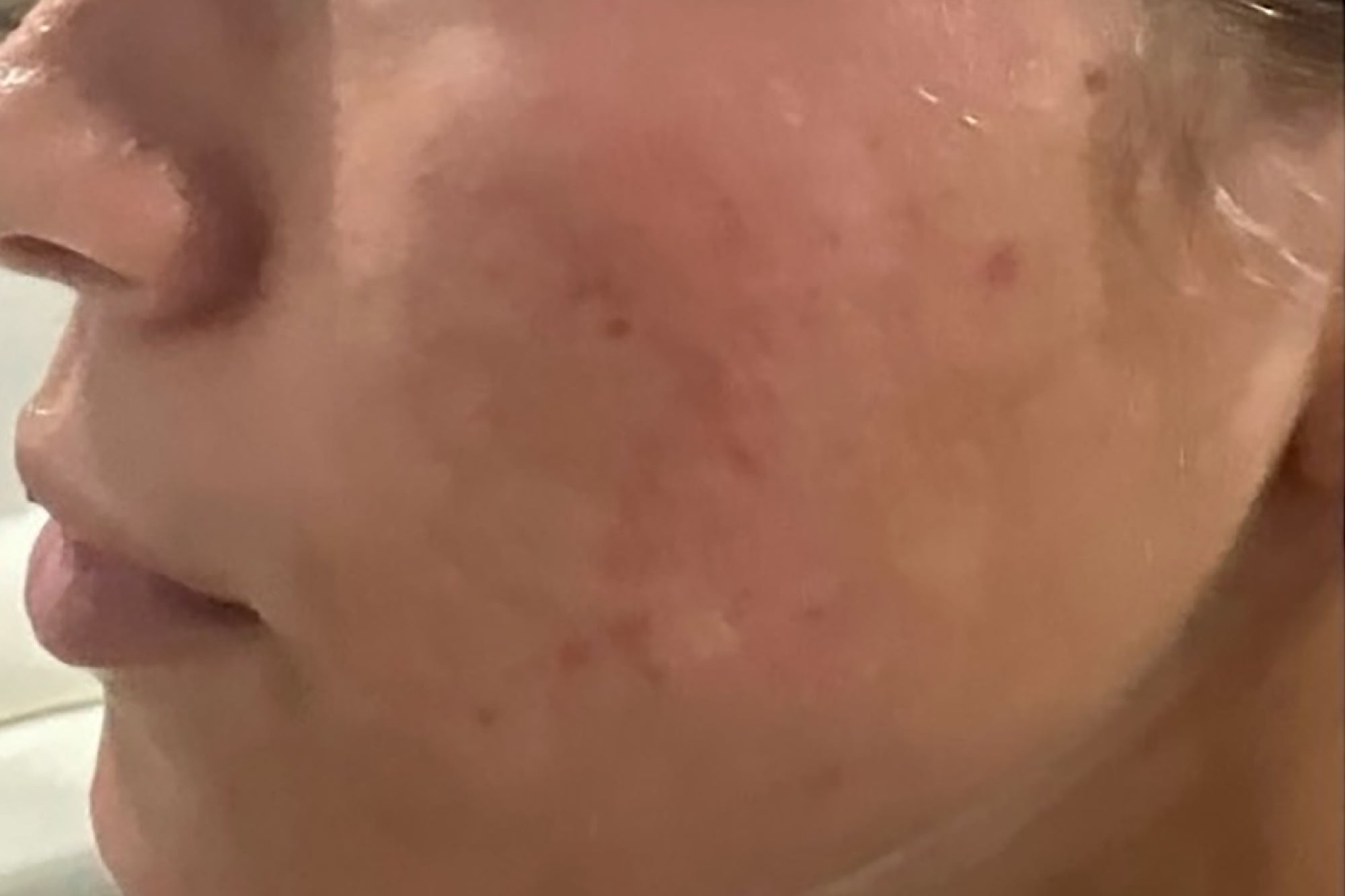 NEOVA 15 Minute Reset Mask – after: Close-up of cheek showing calmer-looking skin with improved tone and smoother appearance following use of the facial mask.