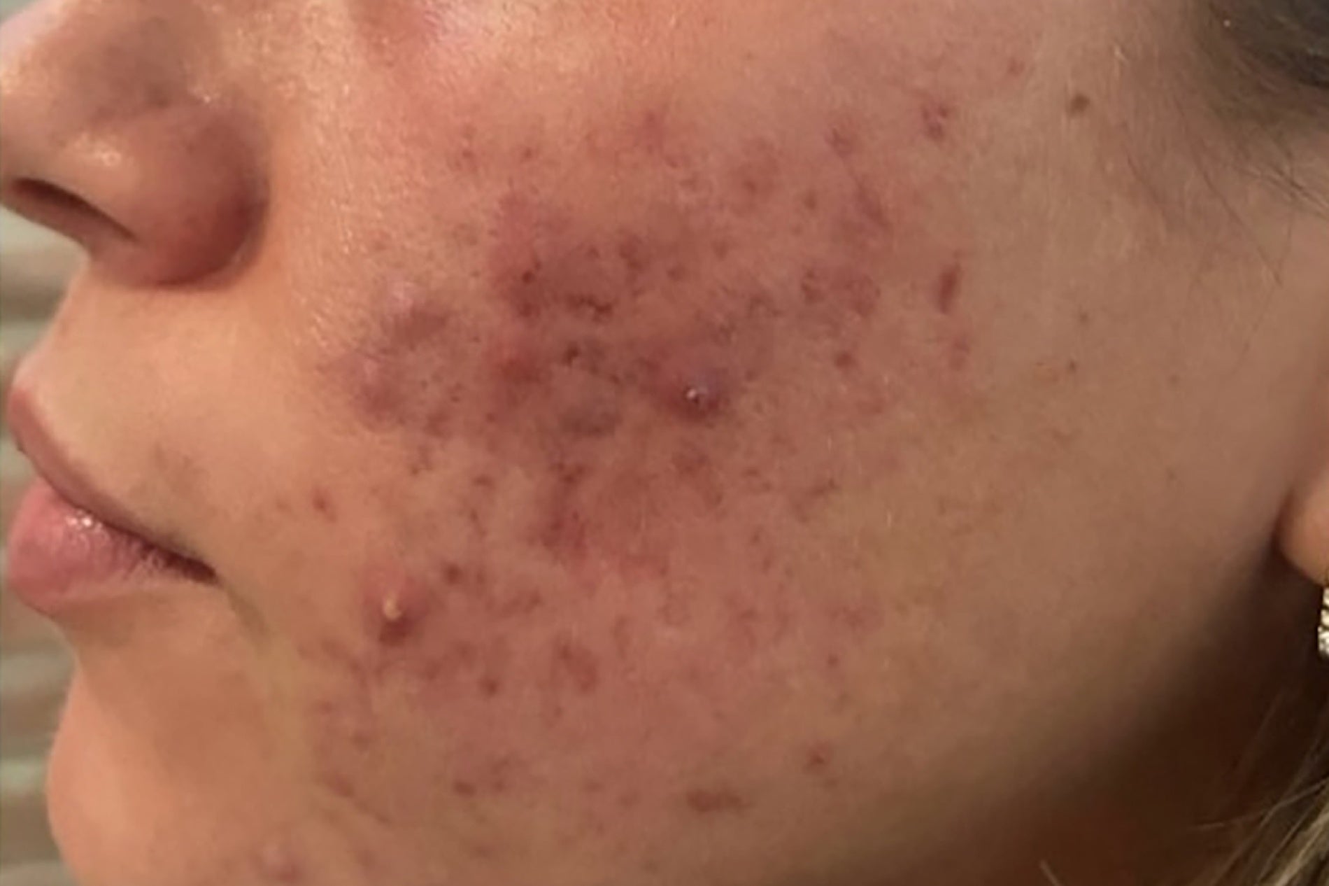 NEOVA 15 Minute Reset Mask – before: Close-up of cheek showing visible redness, uneven texture, and signs of irritation prior to use of product.