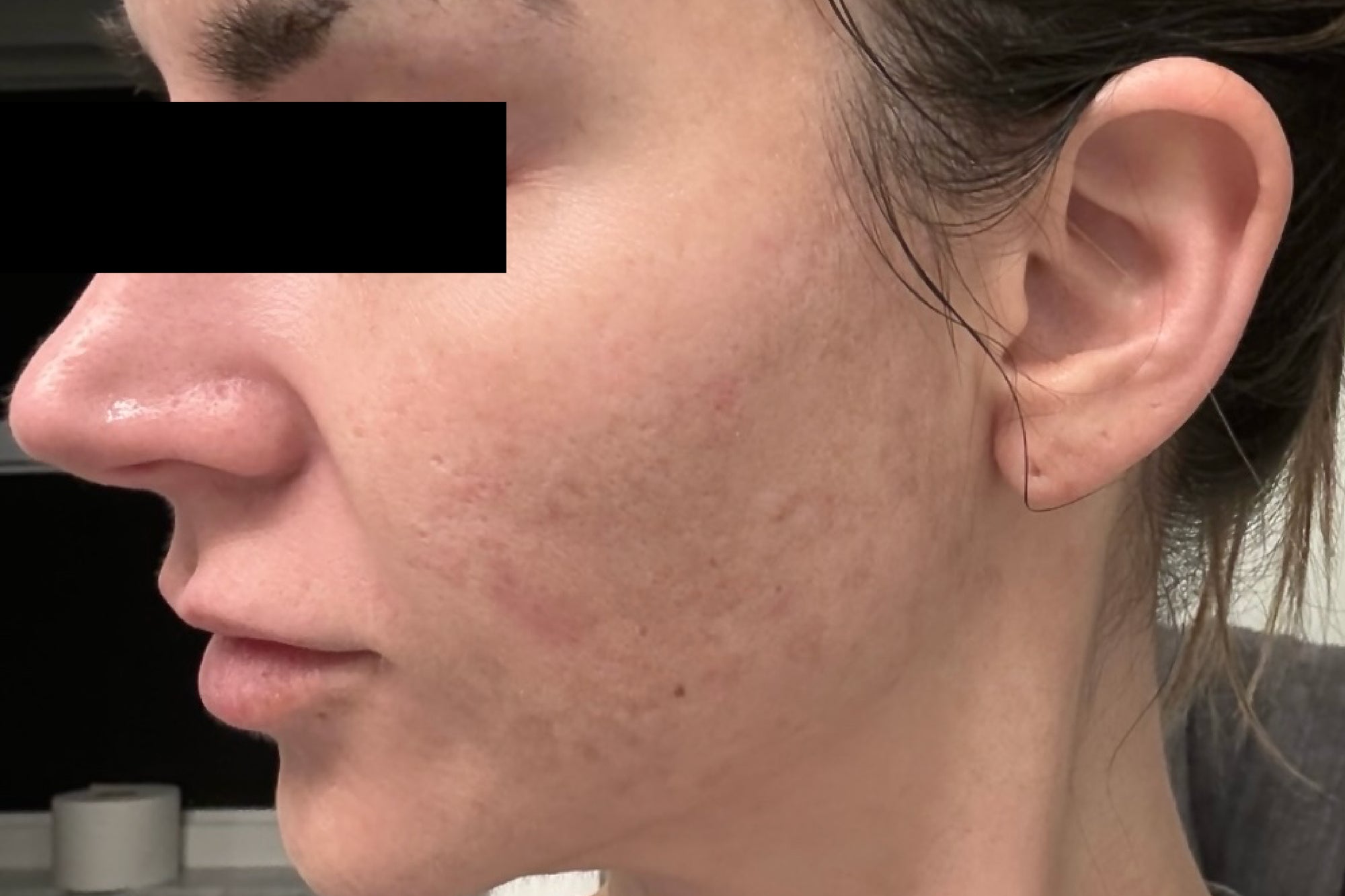NEOVA 5 Second Daily Peel – after: Close-up of cheek showing smoother-looking skin texture and more refined appearance following use of product.