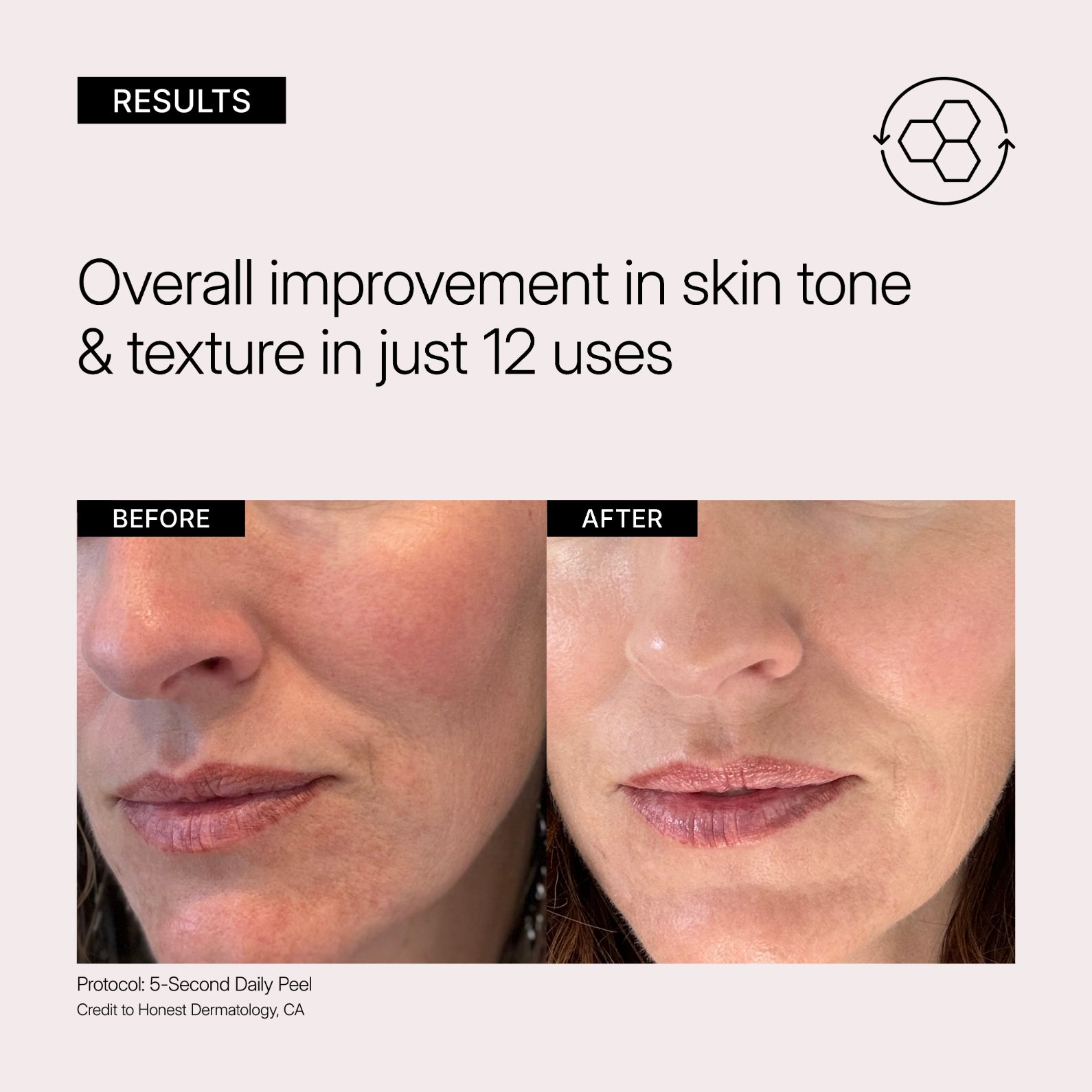 NEOVA 5-Second Daily Peel - Before and after comparison of a woman's face showing skin tone and texture improvement with 12 uses of 5 Second Daily Peel pads.