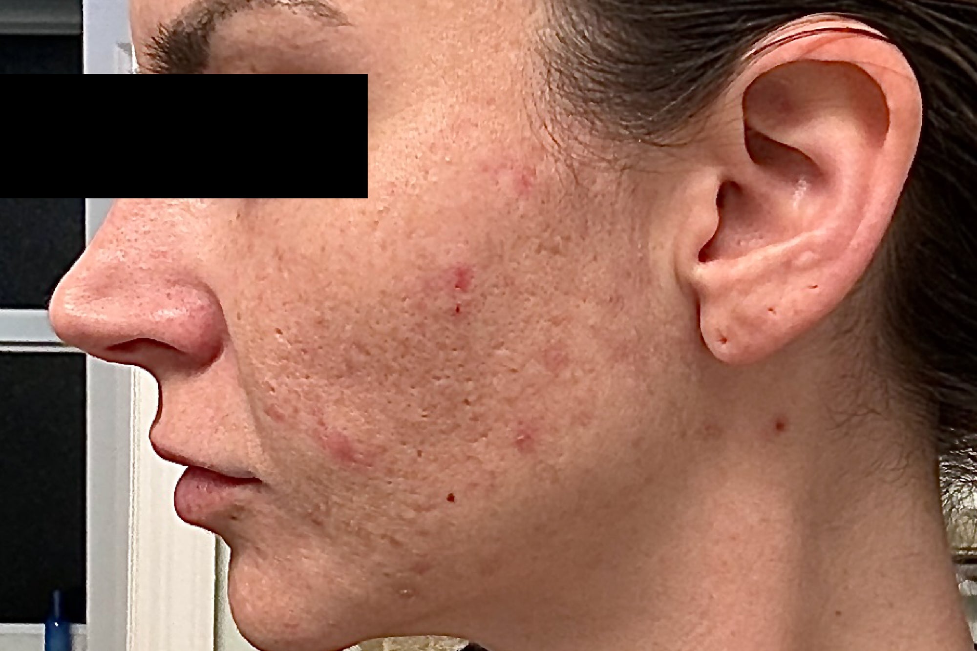 NEOVA 5 Second Daily Peel – before: Close-up of cheek showing uneven texture, visible pores, and dull-looking skin prior to use of product.