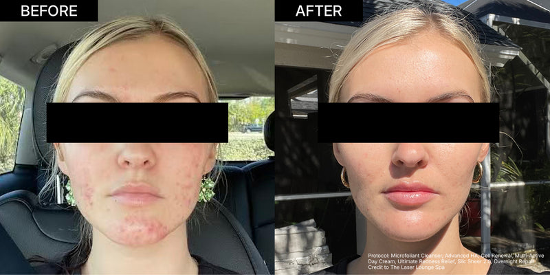 NEOVA Alpha Beta Retinol | Before-and-after comparison of a woman’s skin showing visible reduction in acne, redness, and inflammation, with a clearer, smoother, more even-toned complexion after treatment.