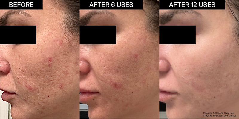 NEOVA Alpha Beta Retinol before and after clinical results demonstrating visible improvement in skin texture, pore size, and blemish reduction over 12 uses. This progression shows the efficacy of the 5-Second Daily Peel in resurfacing and clarifying acne-prone skin.