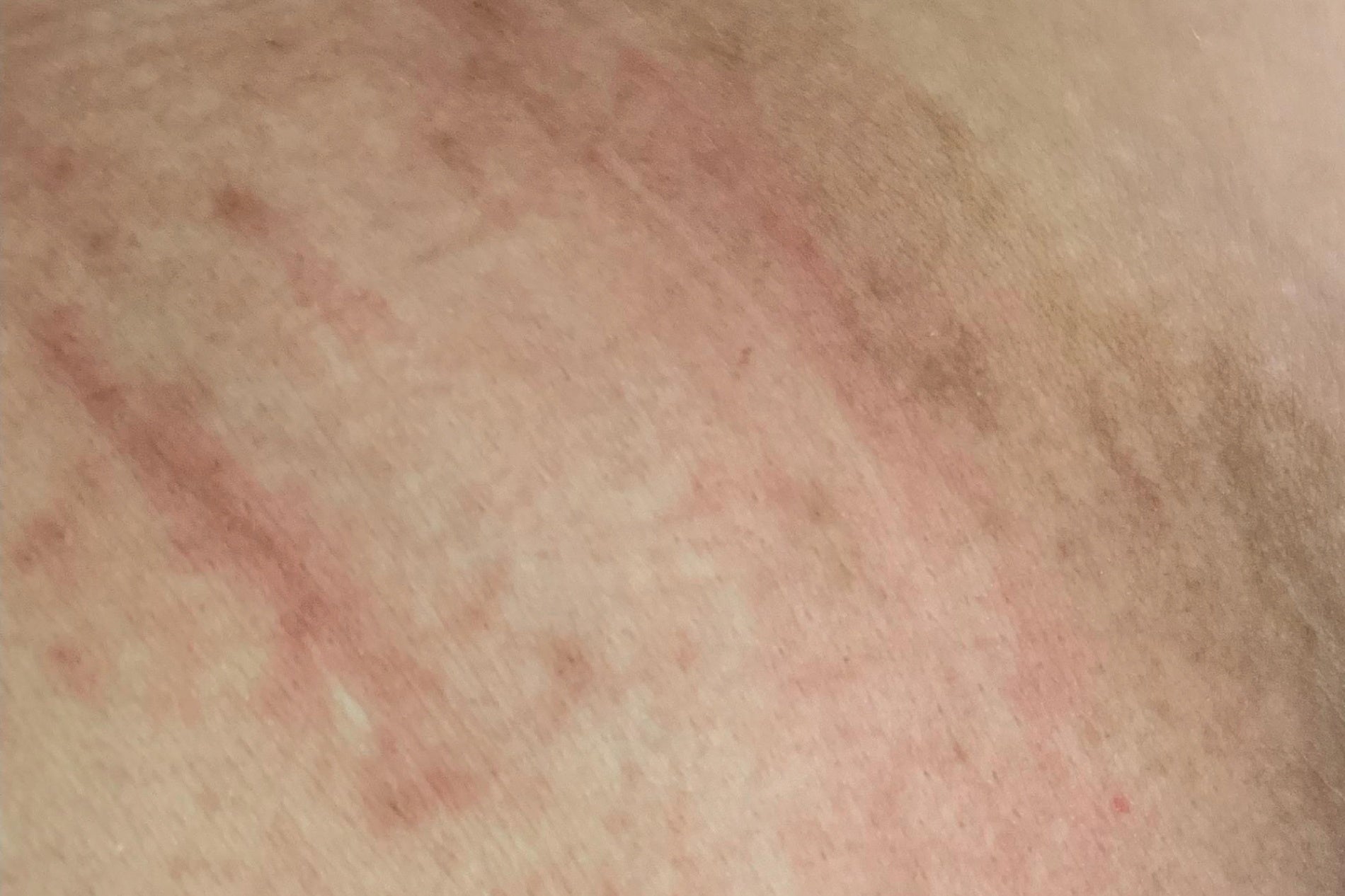 NEOVA Body Repair – before: Close-up of skin showing dryness, redness, and uneven texture on body prior to use of product.
