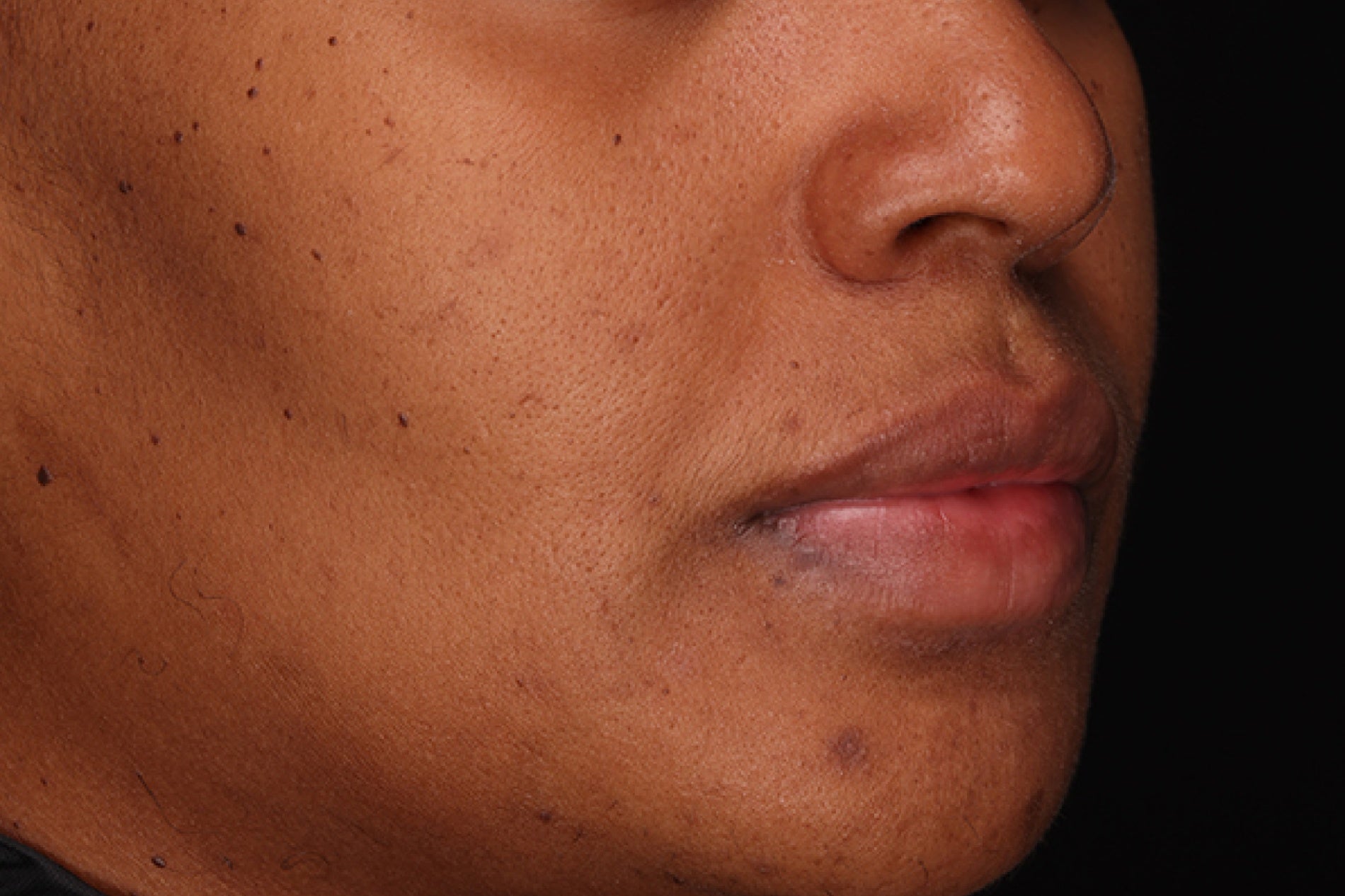 NEOVA C 20+ Serum – after: Close-up of lower face showing brighter, more even-looking skin tone and improved overall clarity following use of product.