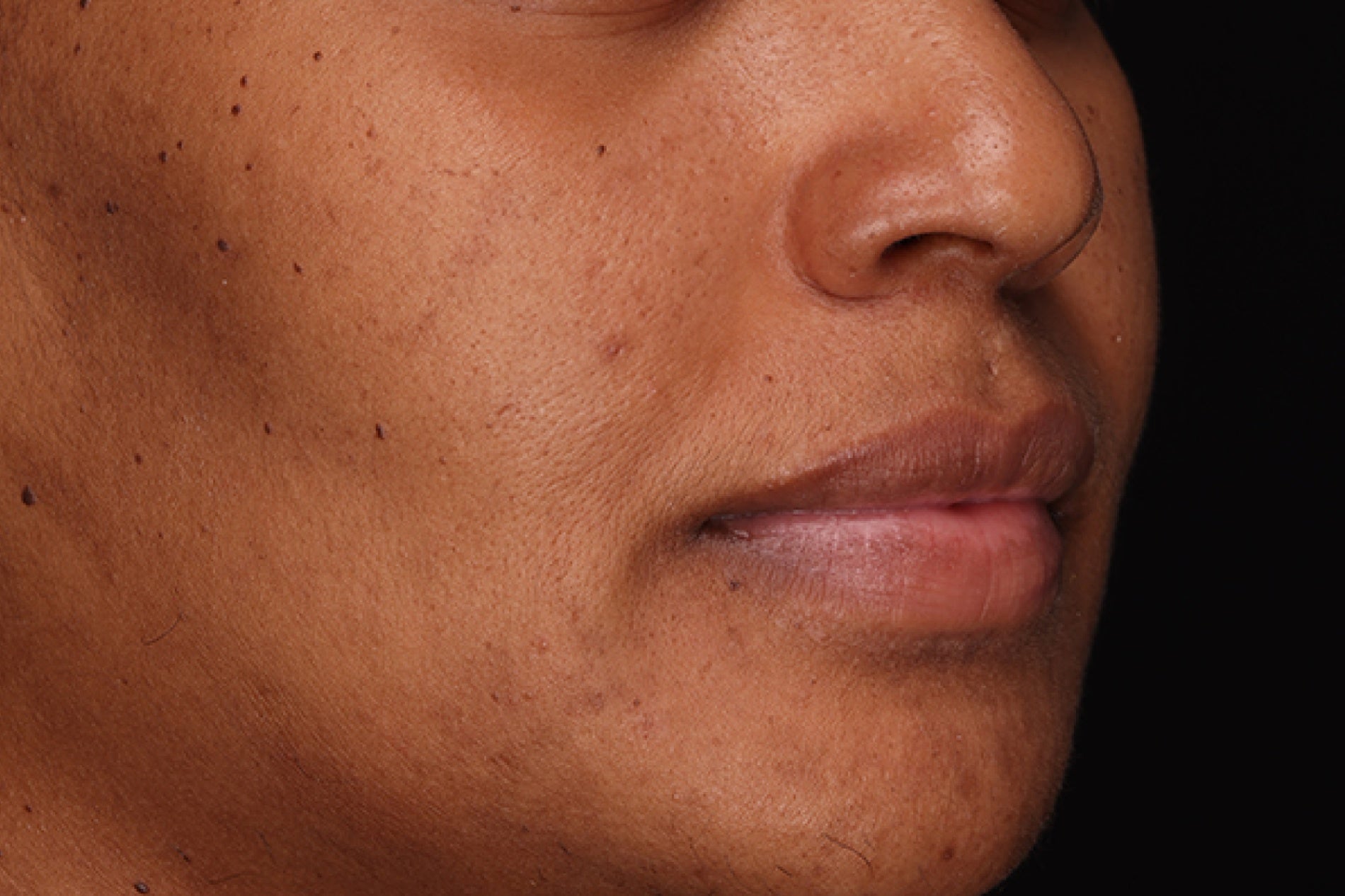 NEOVA C 20+ Serum – before: Close-up of lower face showing uneven skin tone, discoloration, and dullness prior to use of the vitamin c serum.
