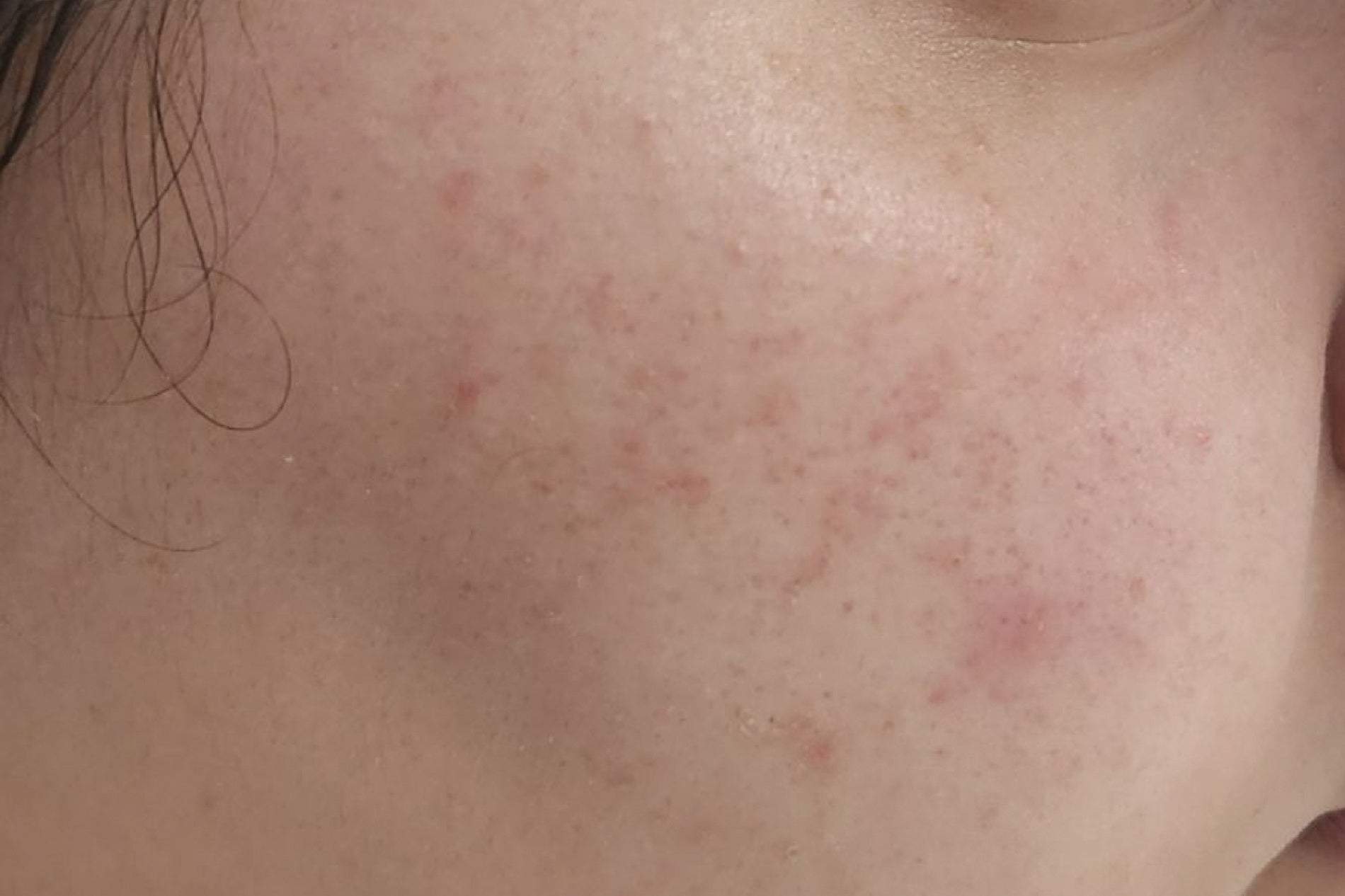 NEOVA Cell Renewal – after: Close-up of skin showing improved-looking texture and more even tone following product use.