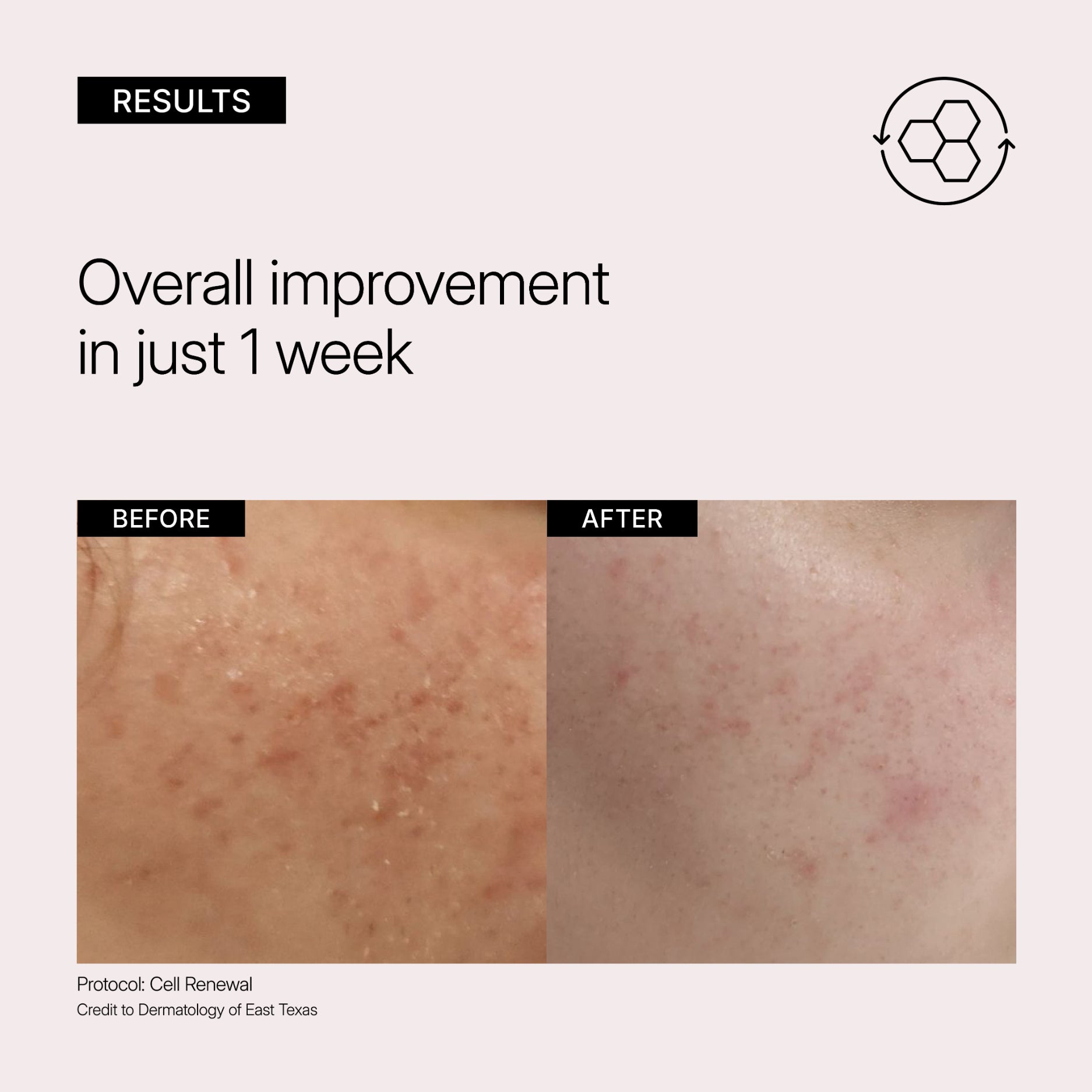 NEOVA Cell Renewal - before and after comparison close up showing visible smoothening and a reduction of hyperpigmentation in just 1 week of use.