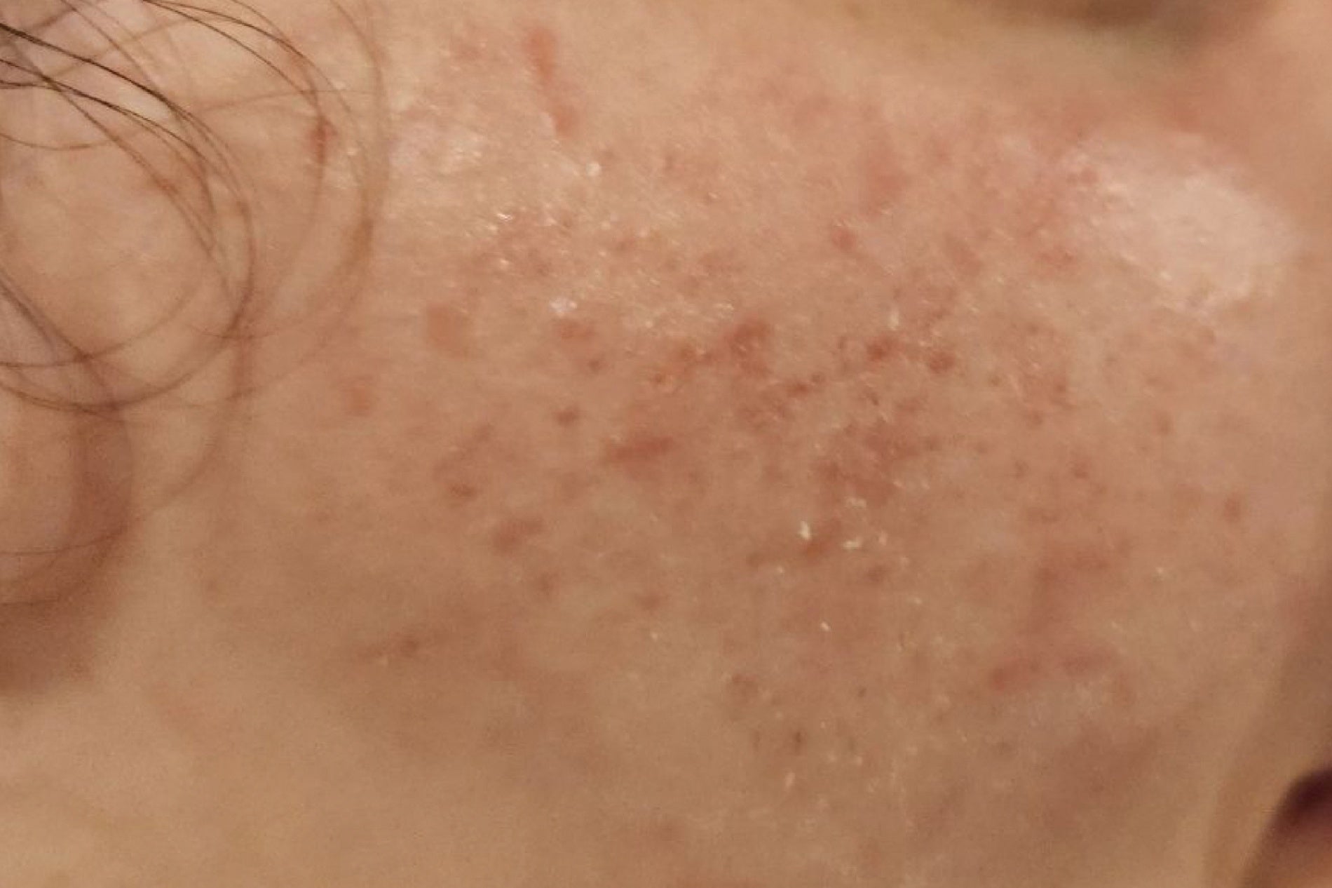NEOVA Cell Renewal – before: Close-up of cheek showing uneven texture, redness, and visible signs of aging prior to use of product.
