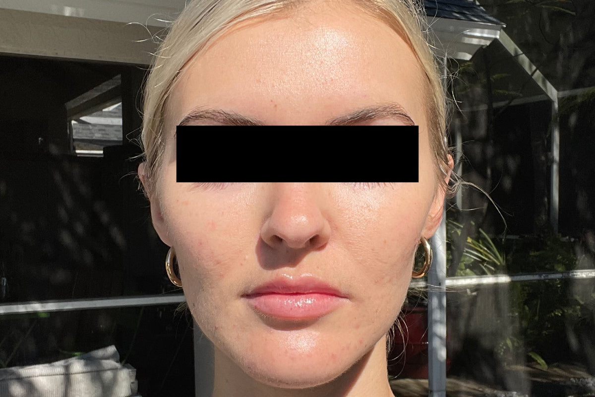 NEOVA Clarifying Brightening System – after: Close-up of face showing more even-looking skin tone, reduced discoloration, and improved clarity following use of product.