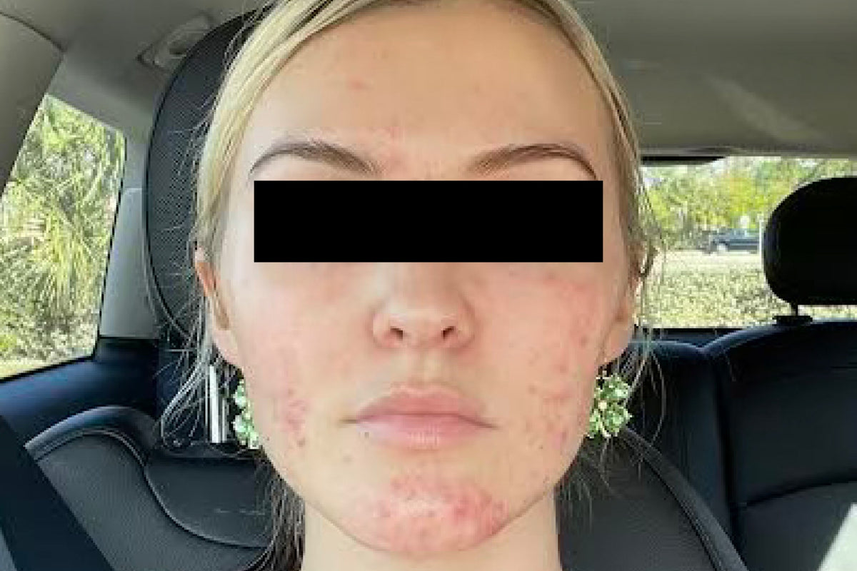 NEOVA Clarifying Brightening System – before: Close-up of face showing uneven skin tone, discoloration, and visible redness prior to use of product.