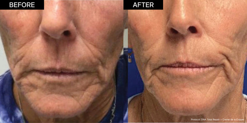 NEOVA Copper Peptides | Before and after close-up photos of a woman's lower face and chin, demonstrating the significant reduction of severe wrinkles and folds after using NEOVA DNA Total Repair and Creme de la Copper, which contain powerful copper peptides.