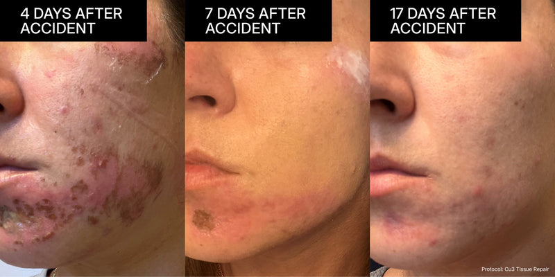 NEOVA Copper Peptides | A three-panel close-up image sequence on a woman's lower face and chin area, demonstrating significant healing after a severe accident using a DNA Copper Peptides (Cu3 Tissue Repair) protocol. The progression shows a reduction from extensive red inflammation and painful, scabbing lesions after 4 days to dramatically smoother and clear skin with only minor residual redness after 17 days, highlighting the product's rapid tissue regeneration.
