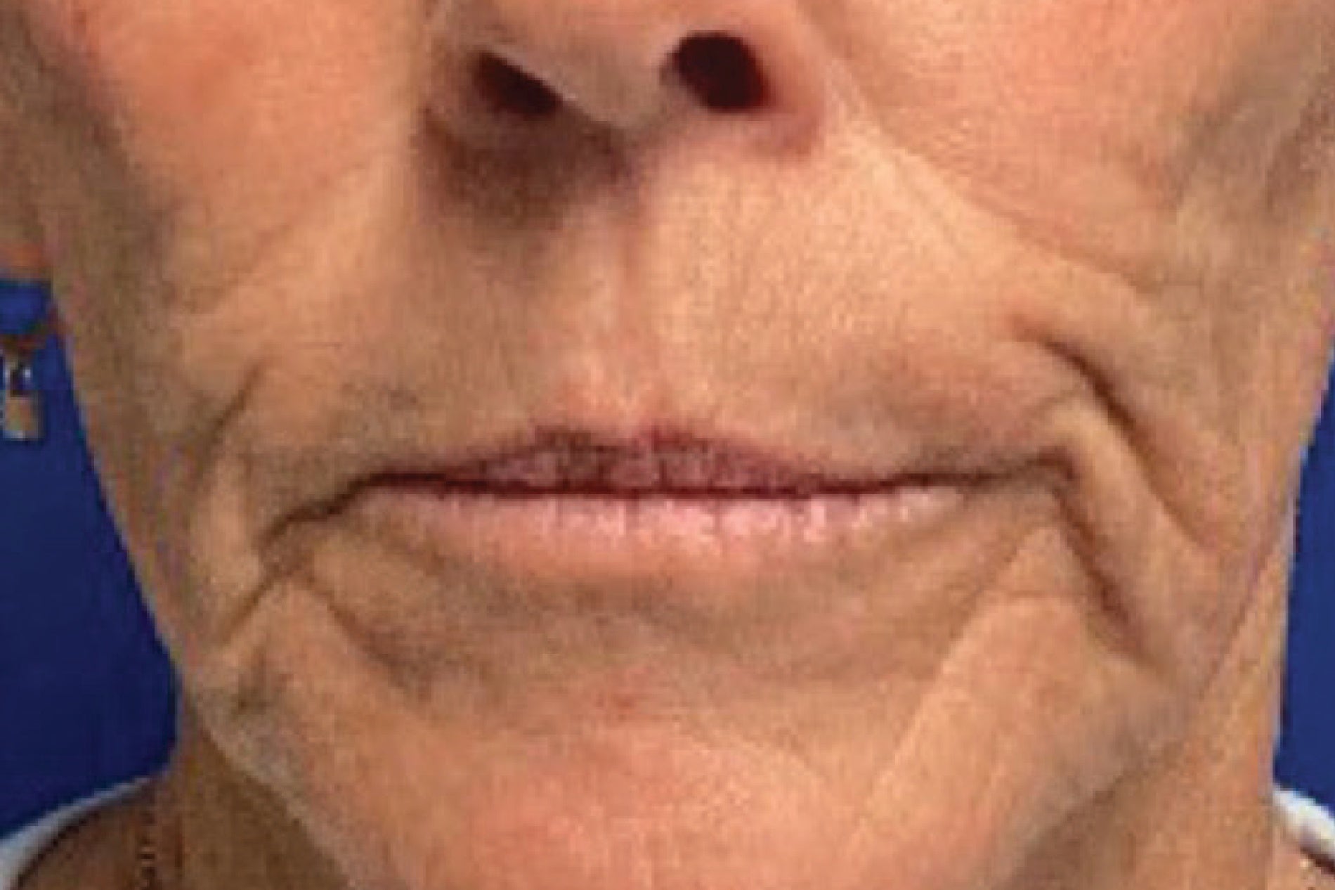 NEOVA Creme de la Copper – after: Close-up of lower face showing smoother-looking skin texture and softened appearance of fine lines and wrinkles following use of the cream.