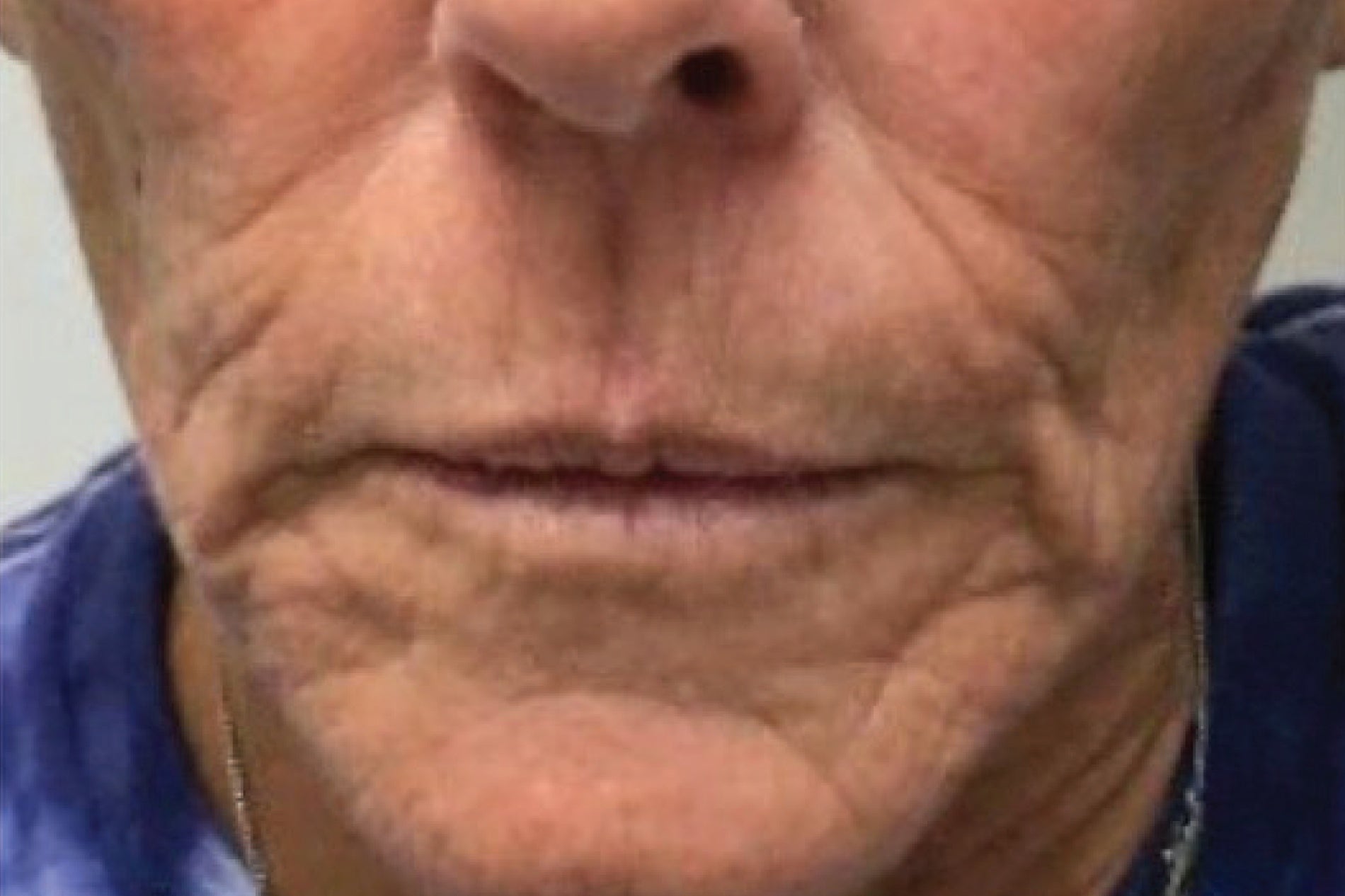 NEOVA Creme de la Copper – before: Close-up of lower face showing the appearance of fine lines and texture irregularities prior to product use.