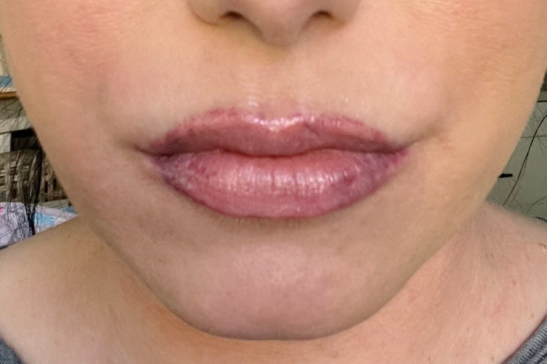 NEOVA CU3 Lip Repair – before: Close-up of lips showing dryness, fine lines, and lack of smoothness prior to use of product.