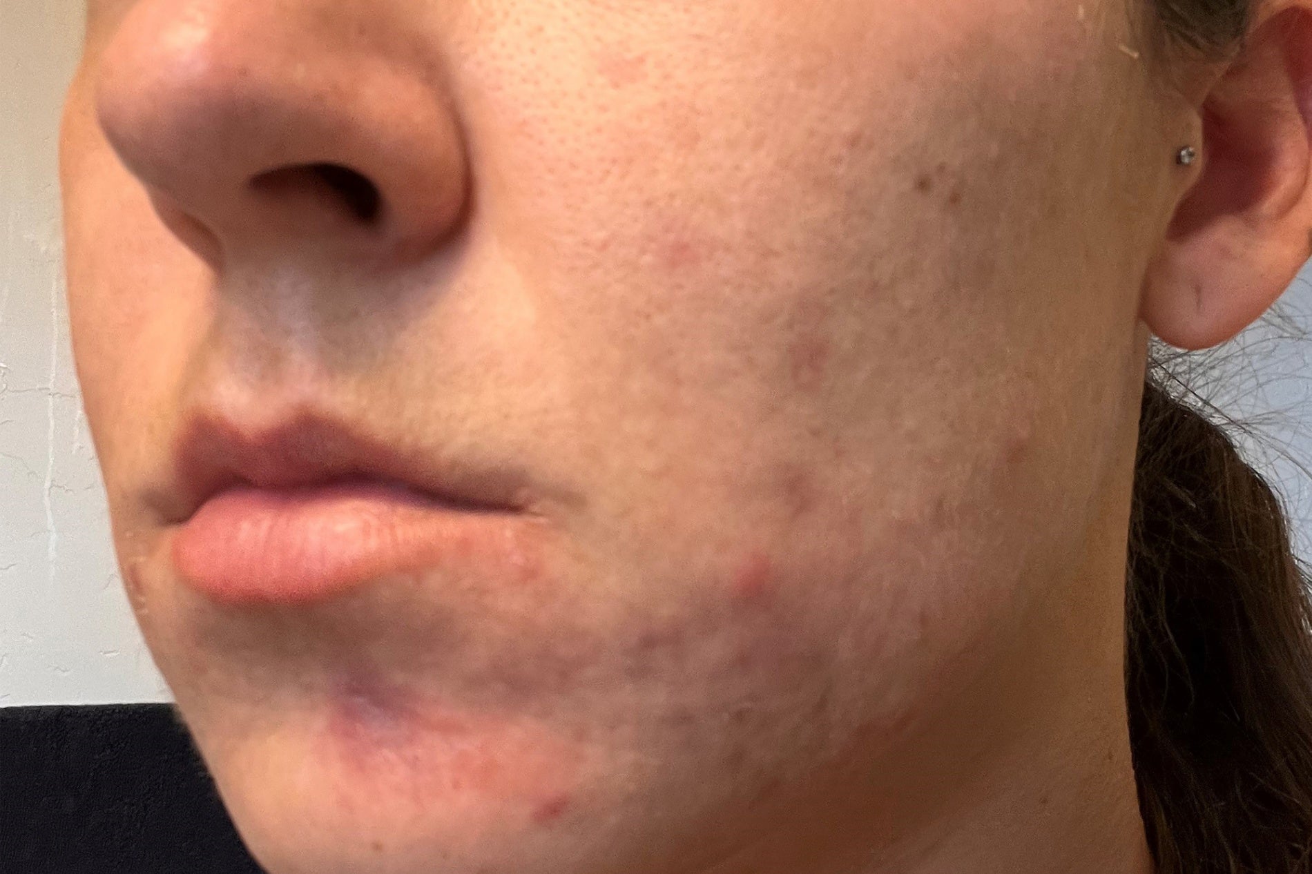 NEOVA CU3 Tissue Repair – after: Close-up of cheek showing reduced redness and improved skin texture with a more even appearance following use of product.