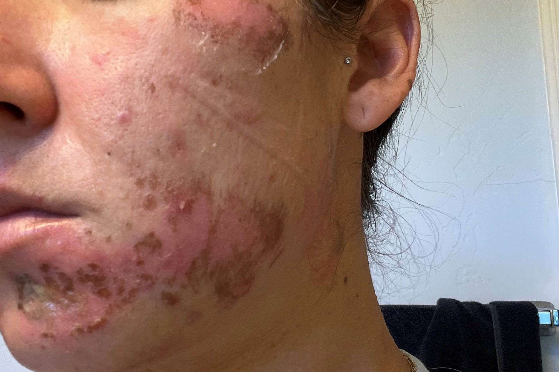 NEOVA CU3 Tissue Repair – before: Close-up of cheek showing redness, irritation, and compromised skin barrier prior to use of product.