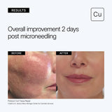 NEOVA Cu3 Tissue Repair educational image showing clinical before and after results with 'Overall improvement 2 days post microneedling' on a gray background.