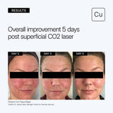 NEOVA Cu3 Tissue Repair educational image showing clinical results and overall improvement after 2, 3, and 5 days post superficial CO2 laser on a gray background.
