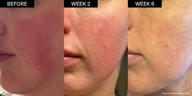 NEOVA DNA CoFactor - Before and after skin treatment comparison showing visible improvement in redness and skin texture over time.