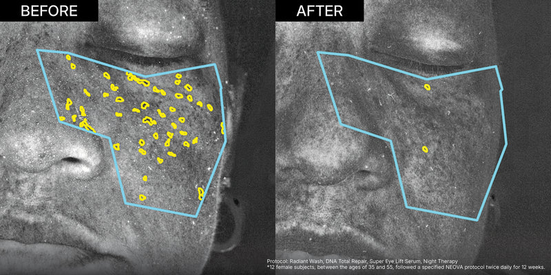 NEOVA DNA Repair clinical study before-and-after image of a woman's face, displaying the significant reduction of UV-induced photodamage after a 12-week clinical protocol.