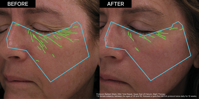 NEOVA DNA Repair | Before-and-after clinical imagery showcasing a significant reduction in deep expression lines and fine wrinkles. The comparison highlights the efficacy of a 12-week DNA repair protocol in restoring skin smoothness and reversing signs of photoaging.