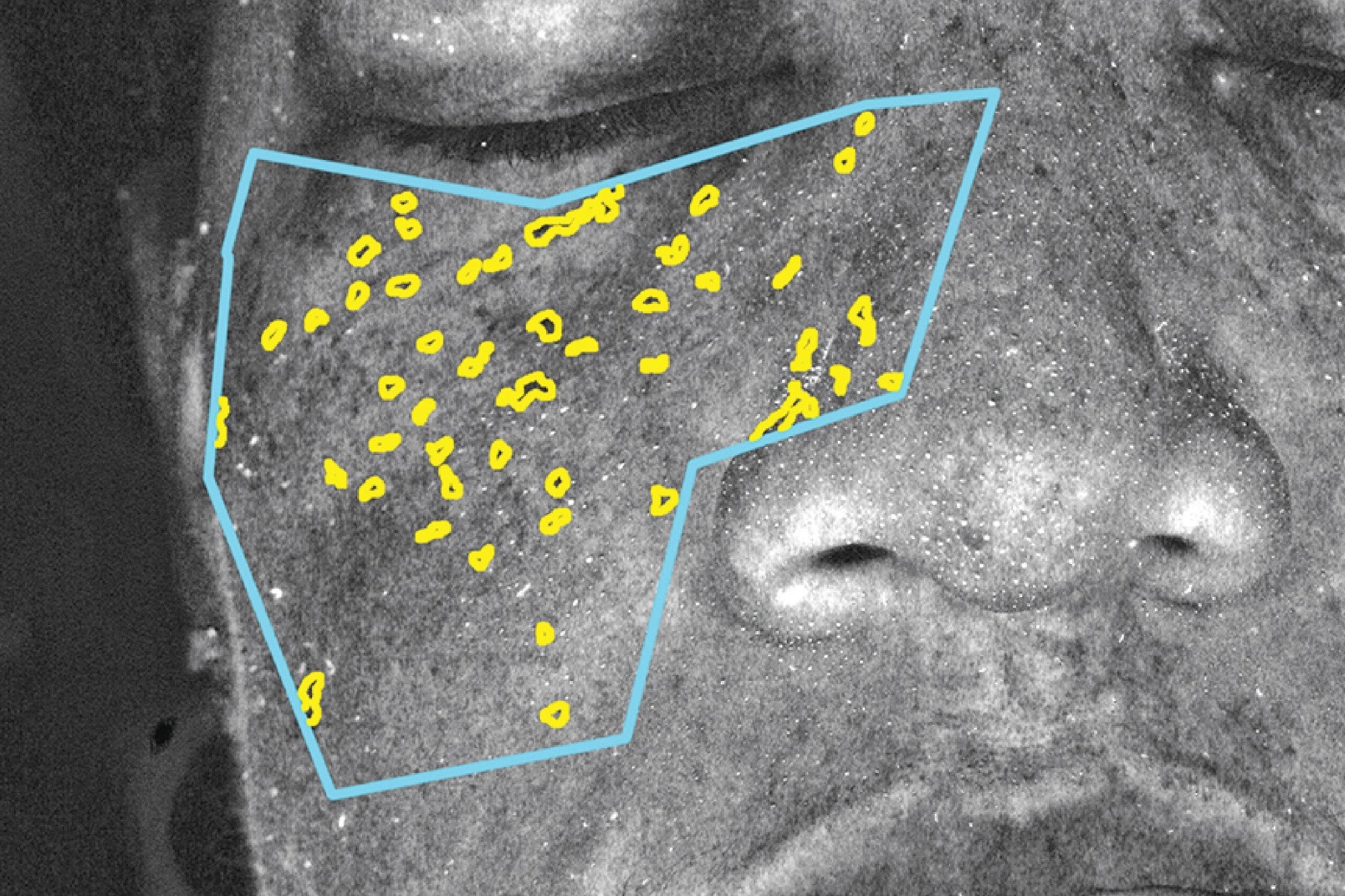 NEOVA DNA Total Repair – before: Close-up of cheek with treatment mapping overlay showing uneven skin tone, sun damage, and visible pigmentation prior to use of product.