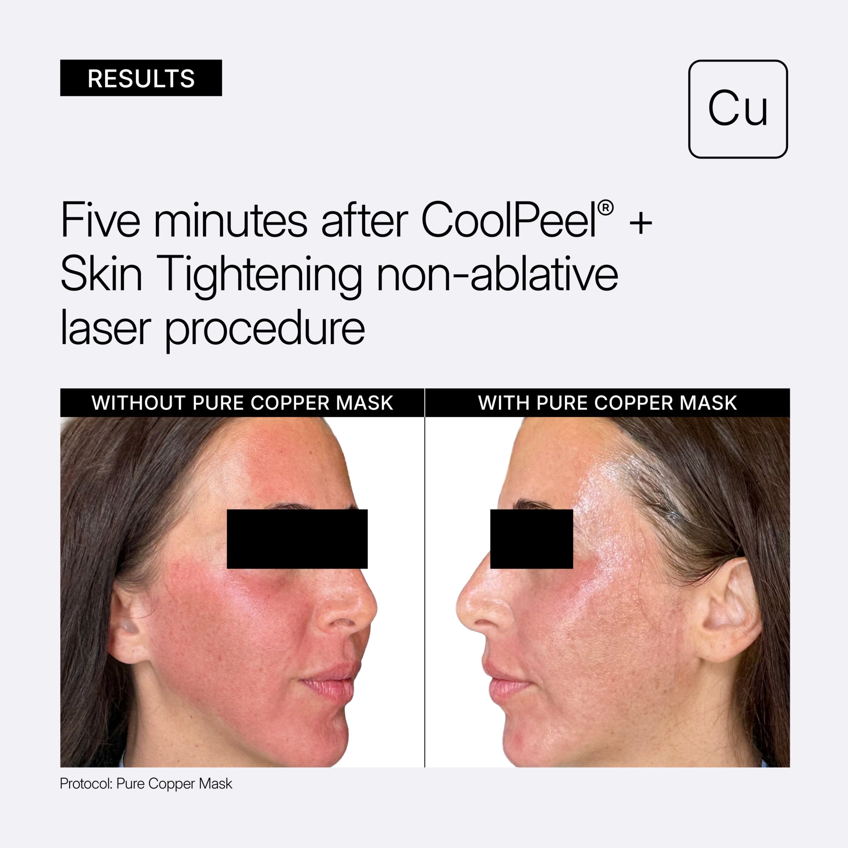 NEOVA - Pure Copper Mask - Before and After Results - Results graphic for a copper mask treatment showing before-and-after skin tightening on a woman's face five minutes after a CoolPeel laser procedure. The left panel is labeled 'WITHOUT PURE COPPER MASK' and shows red, inflamed skin; the right panel is labeled 'WITH PURE COPPER MASK' and shows significantly smoother, tighter skin.