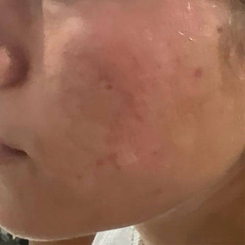 NEOVA Science - Alpha-Beta-Retinol After - Close-up of a person's face after treatment of alpha-beta-retinol with visible reduction in redness and acne spots.