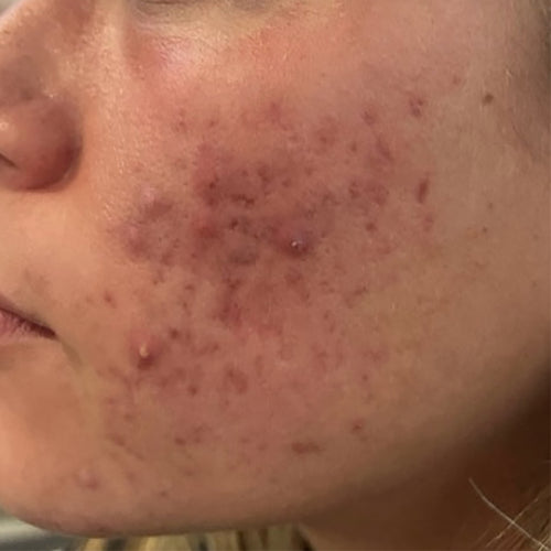 NEOVA Science - Alpha-Beta-Retinol - Close-up of a person's face before treatment of alpha-beta-retinol with visible redness and acne spots.