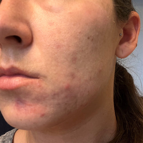 NEOVA Science - Copper Peptides After - Close-up of a person's face with visible reduction in acne and redness on the cheek and jawline.