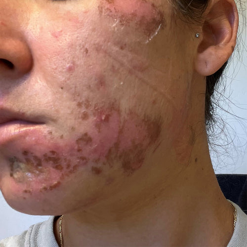 NEOVA Science - Copper Peptides Before - Close-up of a person's cheek and lower jawline with visible raw skin and rough texture before treatment.