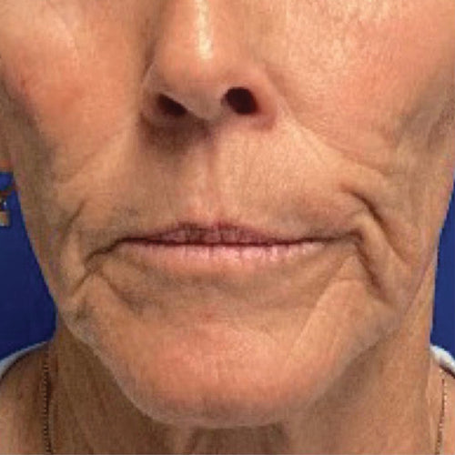 NEOVA Science - DNA Cofactor After - Closeup of an older woman's mouth area with visible reduction in the appearance of fine lines and wrinkles.