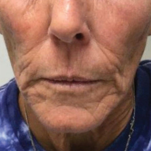 NEOVA Science - DNA Cofactor Before - Close-up of an older person's face with visible wrinkles in the area of the upper mouth.