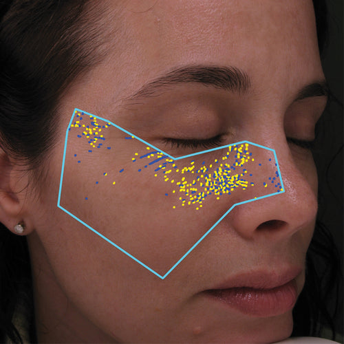 NEOVA Science - DNA Repair - Before - Close-up of a person's face with facial scanning lines and multiple yellow and blue markers under the eye before treatment with the repair serum.