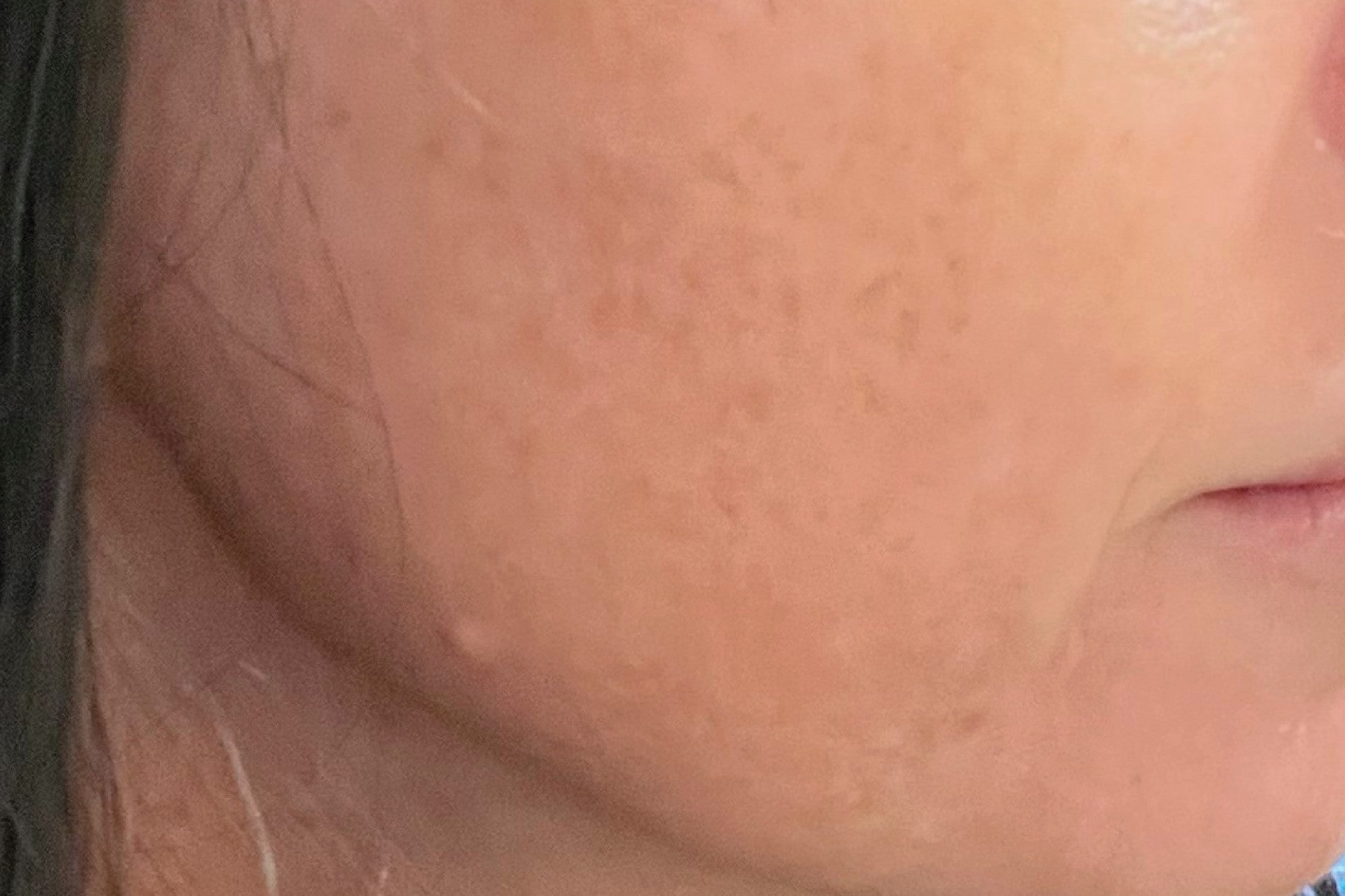 NEOVA Serious Clarity 4X – after: Close-up of cheek showing clearer-looking skin with improved texture and more even tone following use of product.